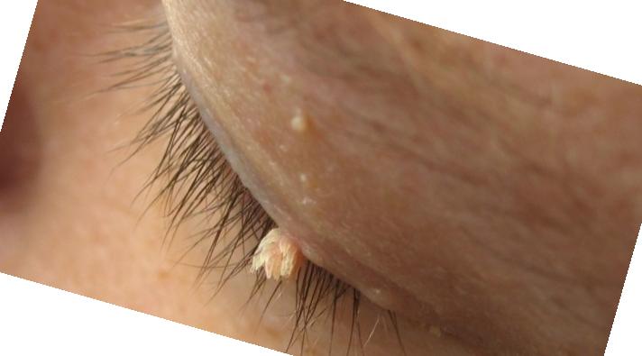 imiquimod without prescription